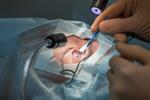 انواع روشهای جراحی چشم برای رفع عیوب انکساری